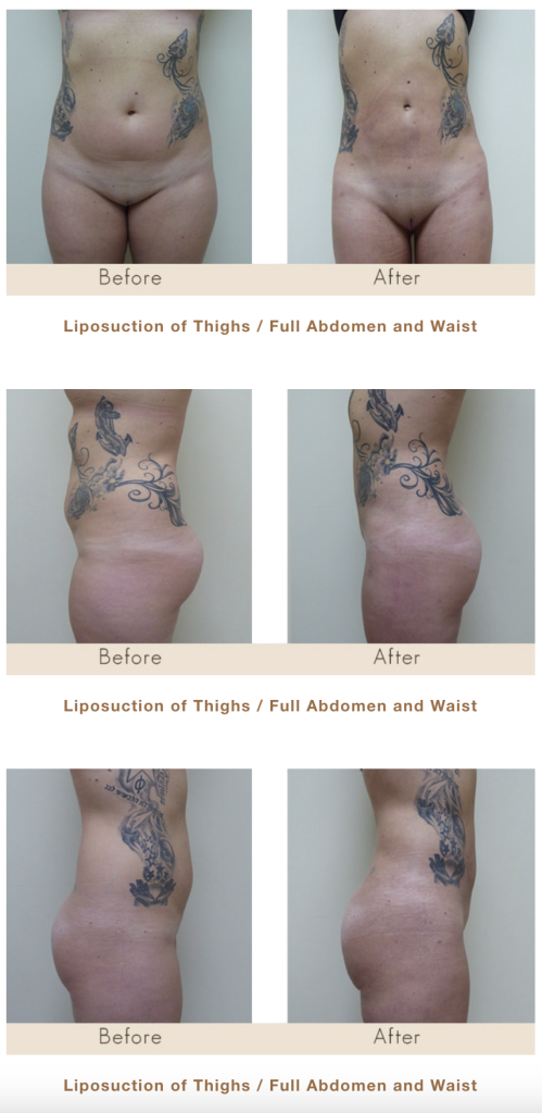 liposuction of thighs. Full abdomen and waist.